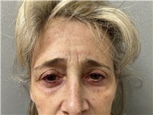 Brow Lift Before Photo by Franklin Richards, MD; Bethesda, MD - Case 49716
