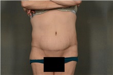 Tummy Tuck After Photo by Ellen Janetzke, MD; Bloomfield Hills, MI - Case 38558