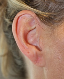 Ear Reconstruction Surgery After Photo by Ellen Mahony, MD; Westport, CT - Case 49621 Ear Reconstruction Surgery After Photo by Ellen Mahony, MD; Westport, CT - Case 49621