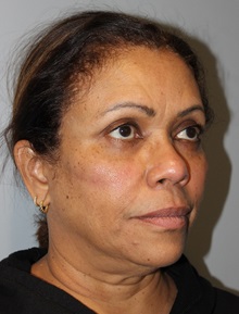 Thread Lift Before Photo by Ellen Mahony, MD; Westport, CT - Case 49623