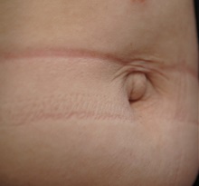 General Reconstruction Before Photo by Ellen Mahony, MD; Westport, CT - Case 49622