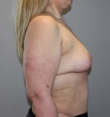 Breast Lift After Photo by Ellen Mahony, MD; Westport, CT - Case 49626