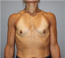 Breast Augmentation Before Photo by Ellen Mahony, MD; Westport, CT - Case 49816 Breast Augmentation Before Photo by Ellen Mahony, MD; Westport, CT - Case 49816