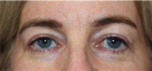 Eyelid Surgery After Photo by Ellen Mahony, MD; Westport, CT - Case 49821 Eyelid Surgery After Photo by Ellen Mahony, MD; Westport, CT - Case 49821