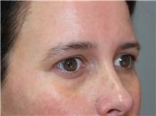 Injectable Fillers Before Photo by Ellen Mahony, MD; Westport, CT - Case 49820