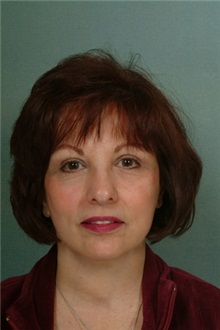 Facelift After Photo by Robert Zubowski, MD; Paramus, NJ - Case 23720