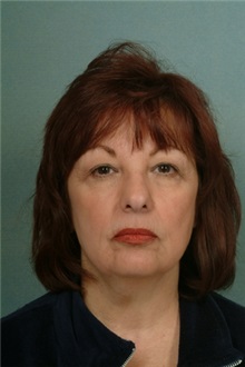 Facelift Before Photo by Robert Zubowski, MD; Paramus, NJ - Case 23720