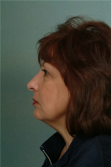 Facelift Before Photo by Robert Zubowski, MD; Paramus, NJ - Case 23720