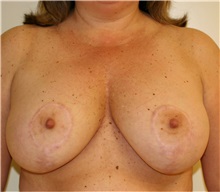 Breast Reduction After Photo by Steve Laverson, MD, FACS; Rancho Santa Fe, CA - Case 37748
