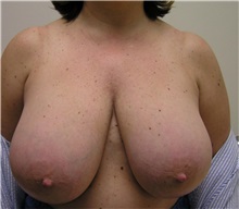 Breast Reduction Before Photo by Steve Laverson, MD, FACS; Rancho Santa Fe, CA - Case 37748
