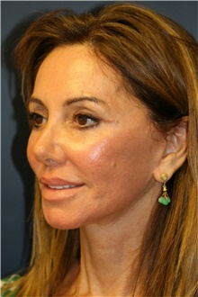Facelift After Photo by Steve Laverson, MD, FACS; Rancho Santa Fe, CA - Case 40392