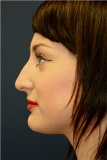 Rhinoplasty Before Photo by Steve Laverson, MD, FACS; Rancho Santa Fe, CA - Case 41793