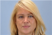 Brow Lift After Photo by Paul Vanek, MD, FACS; Concord, OH - Case 32857