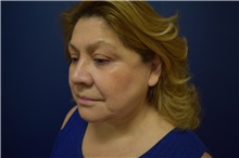 Facelift After Photo by Michael Dobryansky, MD, FACS; Garden City, NY - Case 36745
