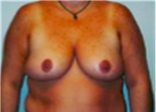 Breast Reduction After Photo by Mariam Awada, MD, FACS; Southfield, MI - Case 40169
