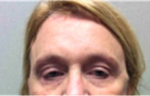 Brow Lift After Photo by Mariam Awada, MD, FACS; Southfield, MI - Case 40217